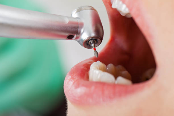Best Urgent Care for Lost Fillings or Crowns in Dimondale, MI